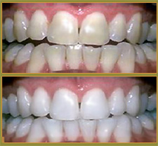 BEFORE & AFTER TREATMENT