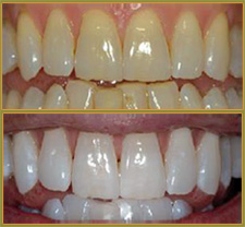 BEFORE & AFTER TREATMENT