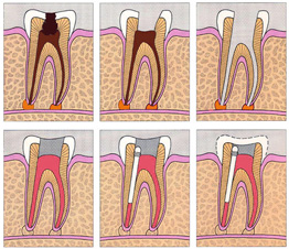 ROOT CANAL TREATMENT